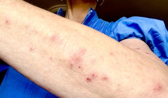 mosquito bites on my arm